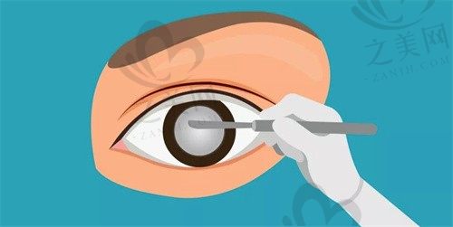 北京华德眼科医院范建国普通型白内障手术12800元起，医生经验丰富，做过的都说好