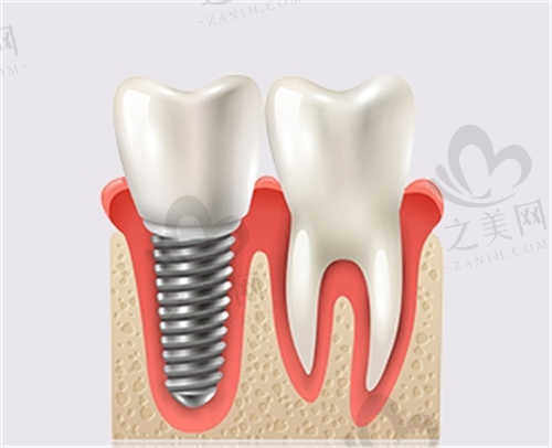 人工种植牙特点