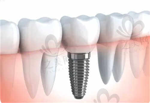 人工种植牙优点