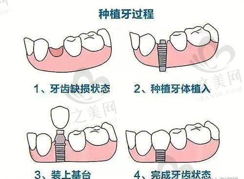 我在山西大同金冠口腔连锁种了一颗奥齿泰牙,感觉还不错