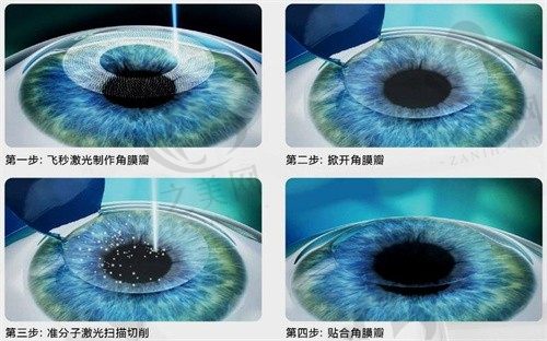 梅州爱尔眼科医院全飞秒手术案例分享:术前术后真实体验!