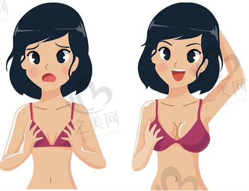 金华亚美整形医院邓泽臣隆胸价格28000元起，创口小，恢复快，效果佳