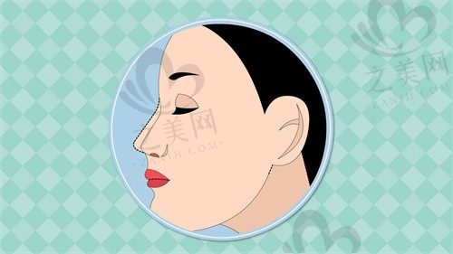 江苏南京施尔美整形医院刘卫鼻修复8000元起，  价格不贵修复技术还好