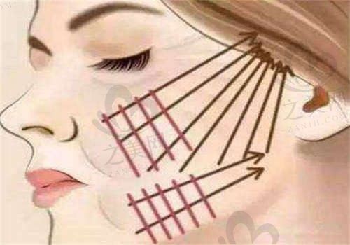 宁波尚丽整形汪栋梁面部提拉价格12000元起，术后自然不紧绷僵硬