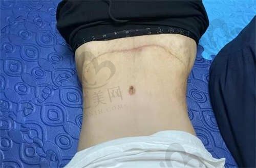 太原华美整形张鹏云腹壁成形术价格16000元起,腹部松弛下坠患者首选