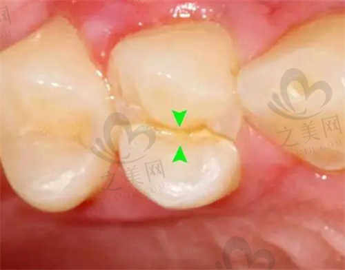 我在泰康拜博口腔拔智齿的感受