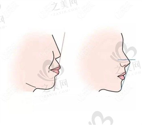 重庆松山医院肖林正颌手术仅需3w元起，打造精致脸型