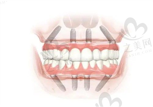 郴州植贝尔口腔门诊部王悟君登腾种植牙3999元起,透明消费值得信赖