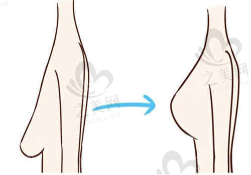 乳房下垂矫正手术前后的变化