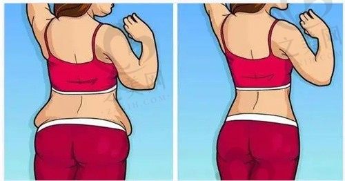  重庆松山医院徐铎腹壁整形3w元起，分享真实整形案例