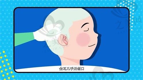  重庆松山医院张朝梅耳再造10w元起，价格稍贵但效果真的好