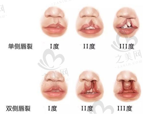 重庆松山医院王涛唇腭裂5000元起，修复唇部瑕疵效果不错   