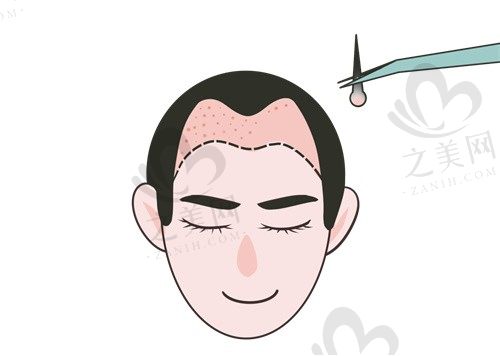 成都大麦微针植发医院怎么样?价格透明且口碑好技术不错