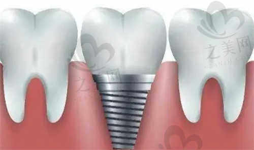 宁夏牙博士口腔种植牙后需要注意什么