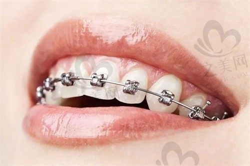 我在大连齿医生口腔门诊做的金属托槽矫正效果很不错,分享我的矫正体验