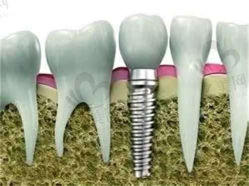 四川达州大竹医附大口腔官文俊种植牙韩系祯诺2980元起,可预约