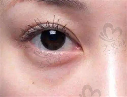 我在深圳济美仁医疗美容做了眼部年轻化,推荐肖晓娟医生技术好