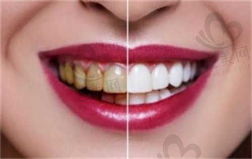 天鑫口腔科李昌轩医生奥齿泰种植牙2980元起，可预约咨询