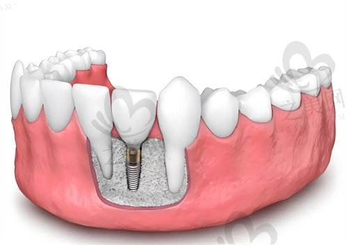 诸暨佳兴口腔门诊部种植牙价格表
