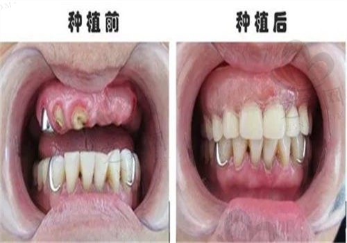 我在天水兔博士口腔医院花了1w种了3颗牙,性价比超高,术后三年了没出过问题