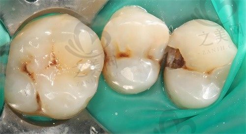 重庆中三口腔花1680元种了一颗牙,手术效果真的好,再也不怕漏风了