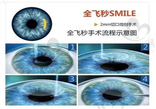 我在徐州瑞博眼科医院花了1w9做了全飞秒,现在视力非常清晰