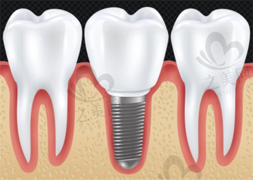 重庆美奥口腔种植牙术前准备
