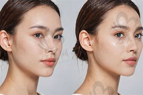 上海盛美瓷医疗美容医院高毅明面部脂肪填充5000元起,成活率高技术好