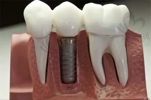 合肥宸贝口腔怎么样?我去他家做了种植牙技术好,术后恢复效果还不错