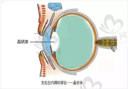 珠海希玛林顺潮眼科医院白内障手术怎么样