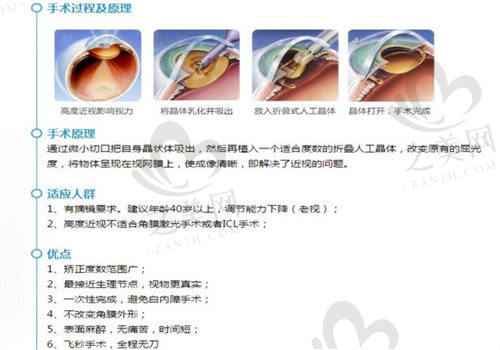 珠海希玛林顺潮眼科医院白内障手术实例