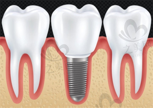 西安小白兔口腔医院种植牙多少钱