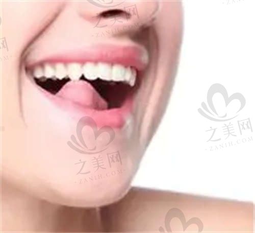 唐山壹颗芽口腔贴面技术挺牛,我去做了瓷贴面,效果立竿见影,牙齿也没有酸痛