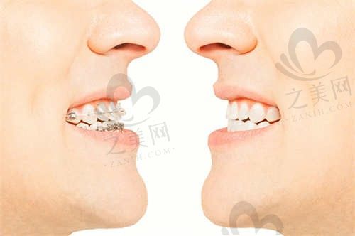 赣州郭君口腔牙齿矫正价格8000元起,矫正牙齿不齐/地包天/龅牙等问题