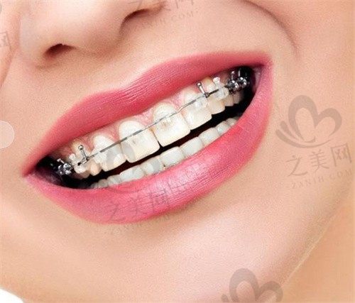 成都西南口腔医院隐适美隐形矫正标准版29999元,恢复快效果好