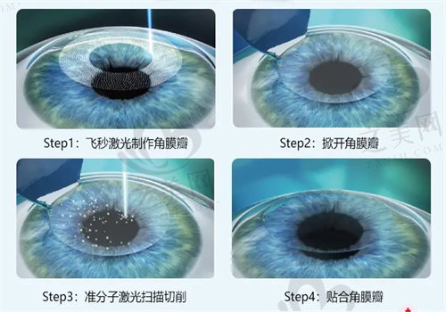 保定新视眼科医院做近视眼手术贵吗