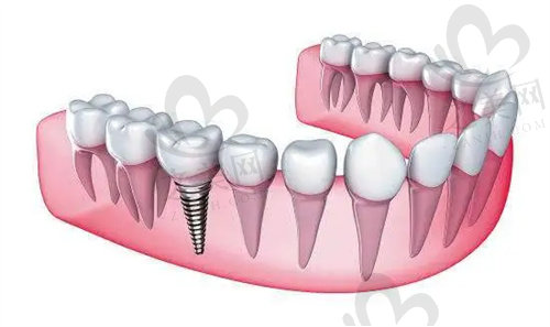 芜湖壹加壹医疗美容门诊部种植牙