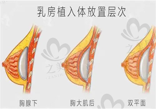 大连铂恩整形医院隆胸价格详情