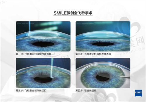 临汾洛基眼科医院周生福医生近视手术优势
