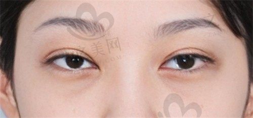 杭州飞秒秒眼科医院全飞秒手术真实体验:价格、过程全公开,告别眼镜后的清晰世界