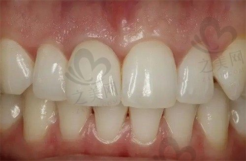 在济南众牙口腔医院做种植牙全过程分享:从方案设计到术后护理,价格透明,我的真实体验
