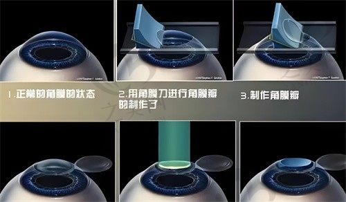 重庆华厦眼科医院汪红全飞秒手术8800元，性价比高，医生技术靠谱