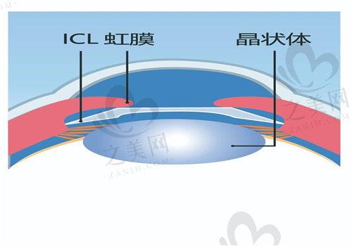 广州维尔视眼科ICL晶体植入术优势