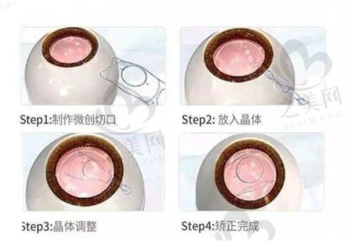 广州维尔视眼科近视手术价格揭秘:ICL晶体植入18000元起,重获清晰视界!
