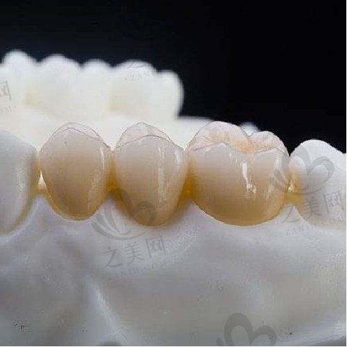  湖州金铂利口腔门诊部邢泽峰瓷贴面1500元起，口碑爆棚