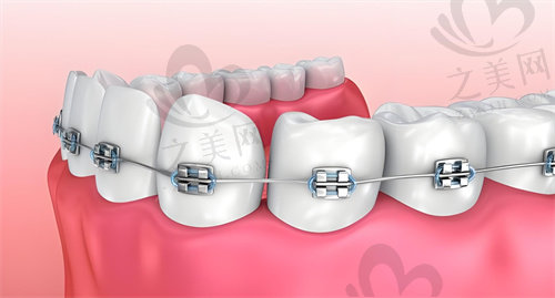 南昌华玉口腔医院金属自锁托槽牙齿矫正优势：
