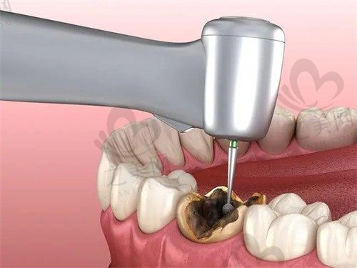      厦门麦芽口腔医院姚江武根管治疗800元起，价格实惠性价比高，很不错的