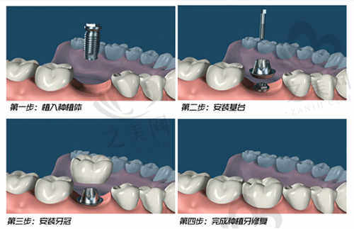 南昌泰康拜博尚东口腔医院部分热门手术价格