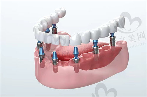 重庆齐美口腔医院种植牙术后注意事项