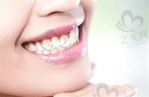  揭阳牙博士口腔门诊部刘方明全瓷牙冠1000元起，价格透明实力雄厚 